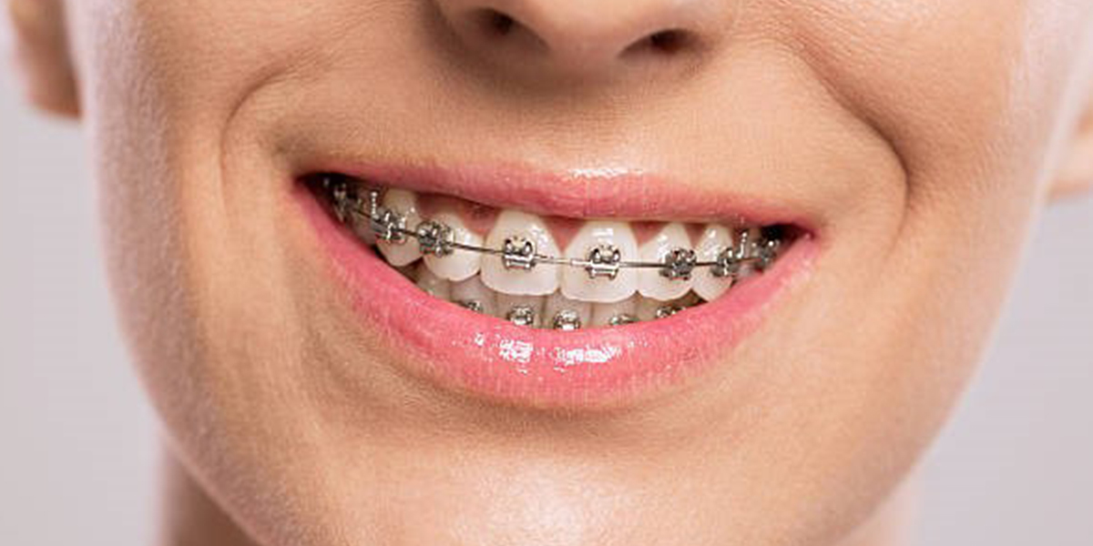 How to choose Braces? Conventional, Damon Smile (PSL) or Aligners?