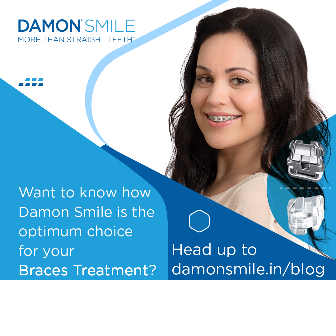 Damon Smile braces