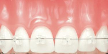 Damon Smile braces