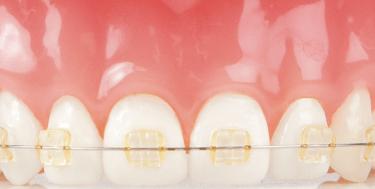 Damon Smile braces